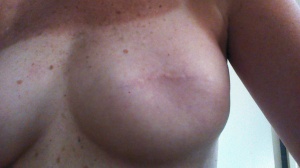 This is not sexy. This is an example of what breast cancer can do.